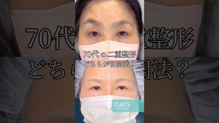 【二重整形】シニアの整形、どちらが切開法?#shorts