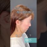 【小顔整形】シニアの小顔整形もお任せください！#shorts