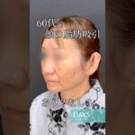 【小顔整形】シニアの小顔整形あり？なし？#shorts