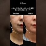 ミドルシニアも脂肪吸引＋糸リフト！#shorts