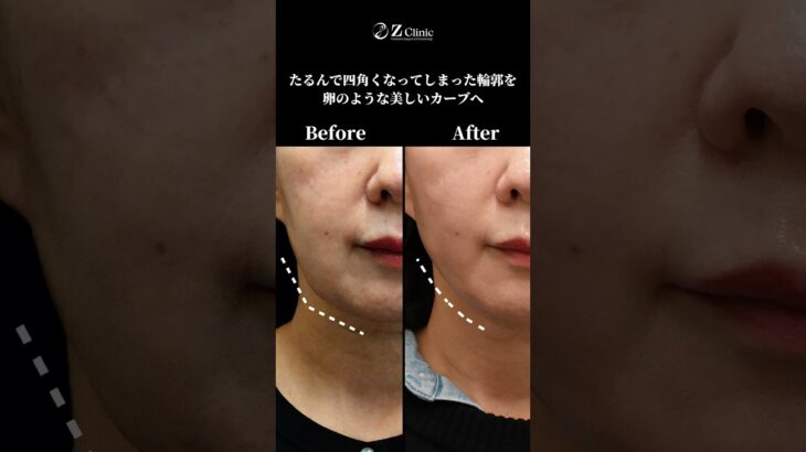 ミドルシニアも脂肪吸引＋糸リフト！#shorts