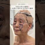 【複合施術】自然な若返りが叶う#shorts