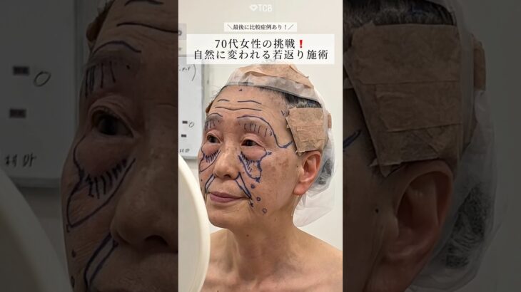 【複合施術】自然な若返りが叶う#shorts