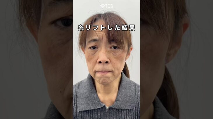 【糸リフト】衝撃の変化💥💥#shorts